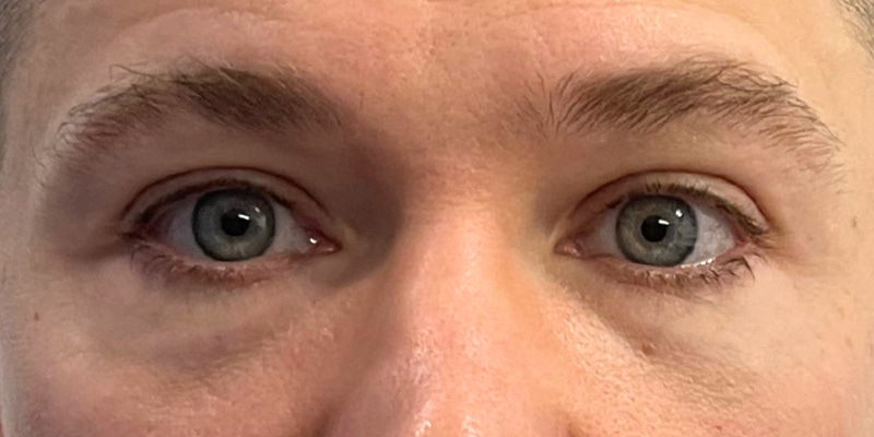 Blepharoplasty Before & After Image