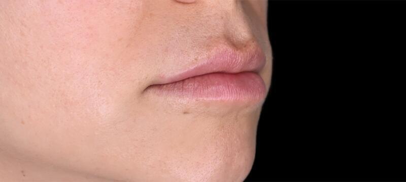 Lip Lift Before & After Image