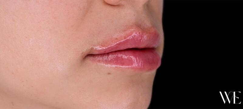 Lip Lift Before & After Image