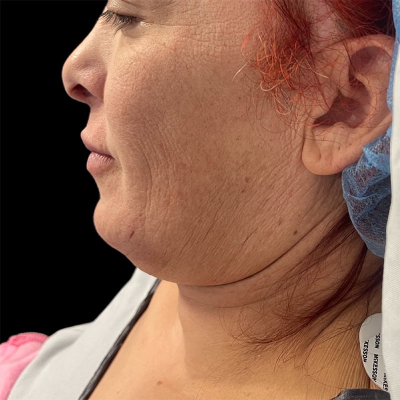 Neck Lift Before & After Image