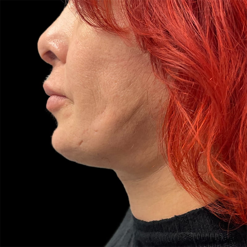 Neck Lift Before & After Image