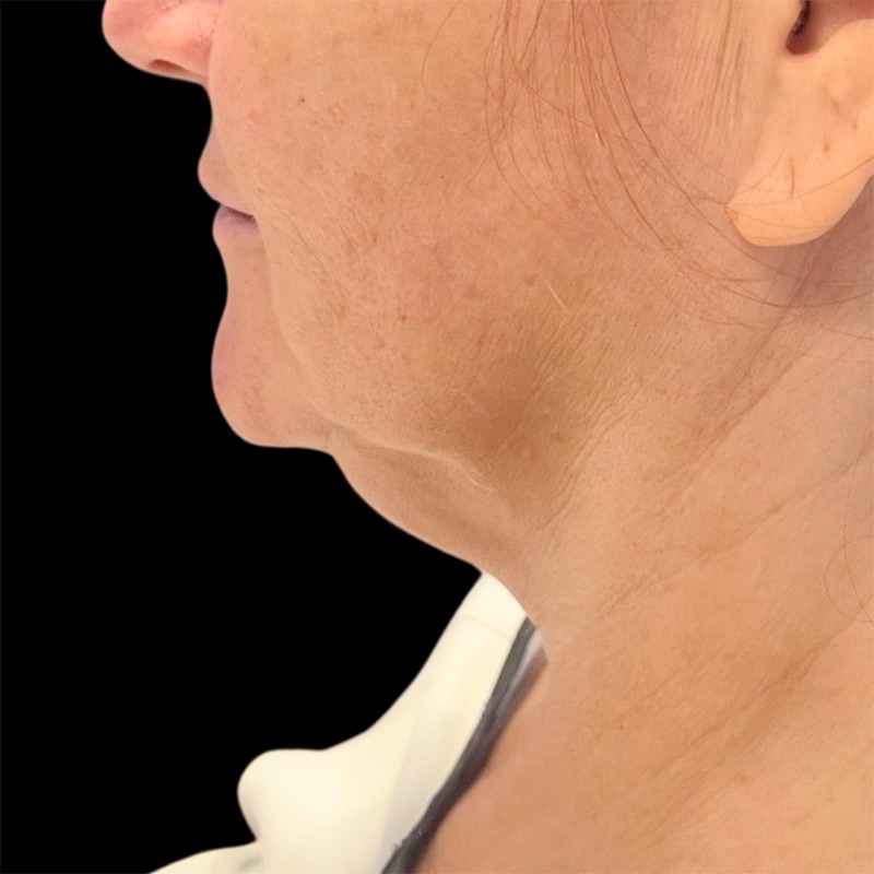 Neck Lift Before & After Image