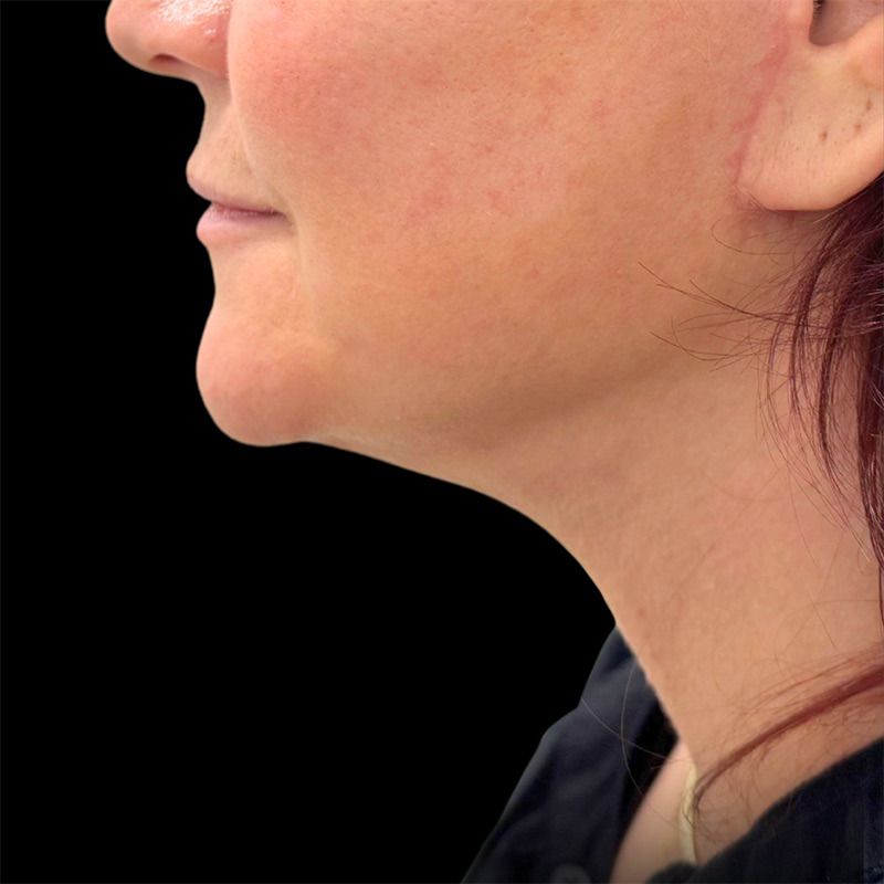Neck Lift Before & After Image