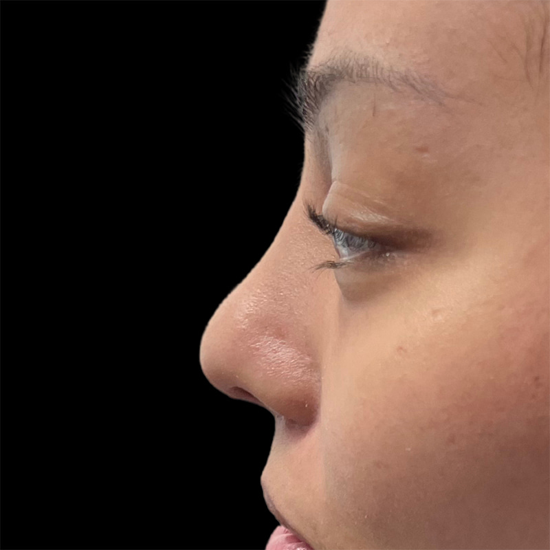 Rhinoplasty Before & After Image