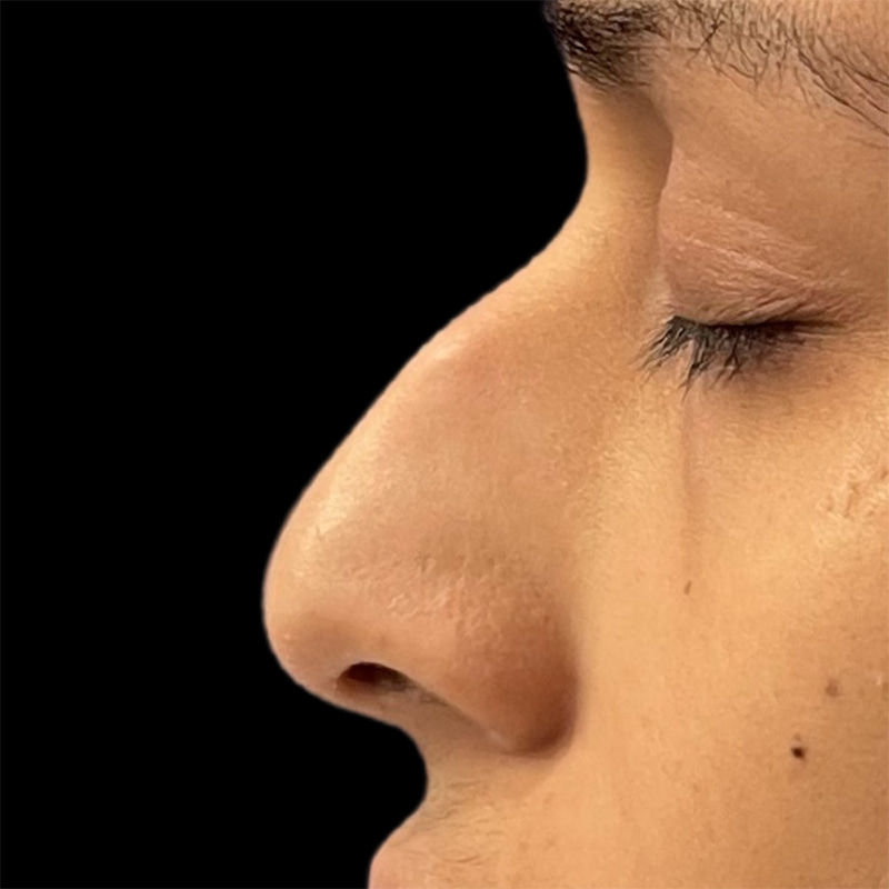 Rhinoplasty Before & After Image