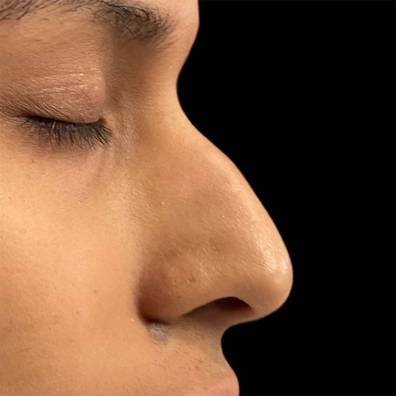 Rhinoplasty Before & After Image