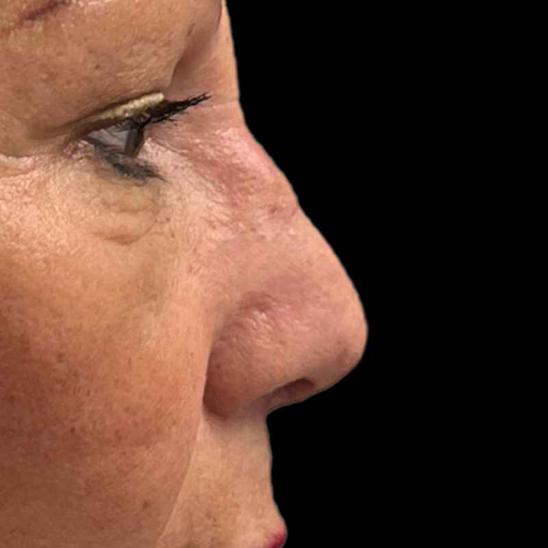 Rhinoplasty Before & After Image