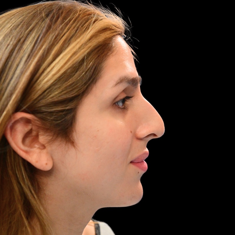 Rhinoplasty Before & After Image
