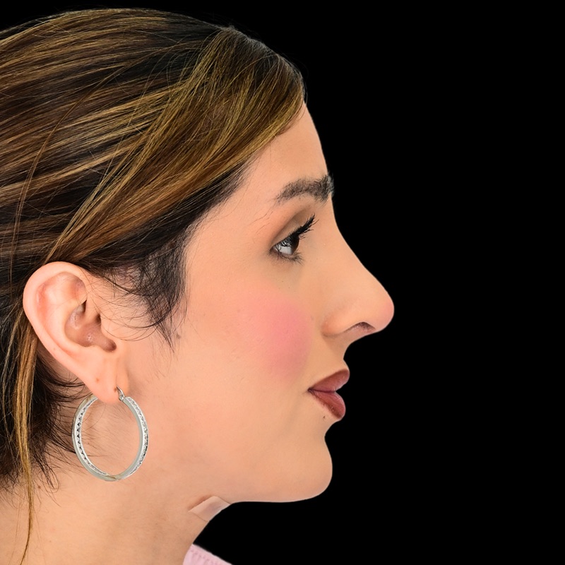 Rhinoplasty Before & After Image