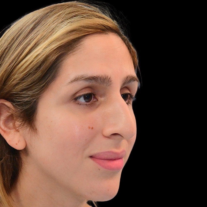 Rhinoplasty Before & After Image