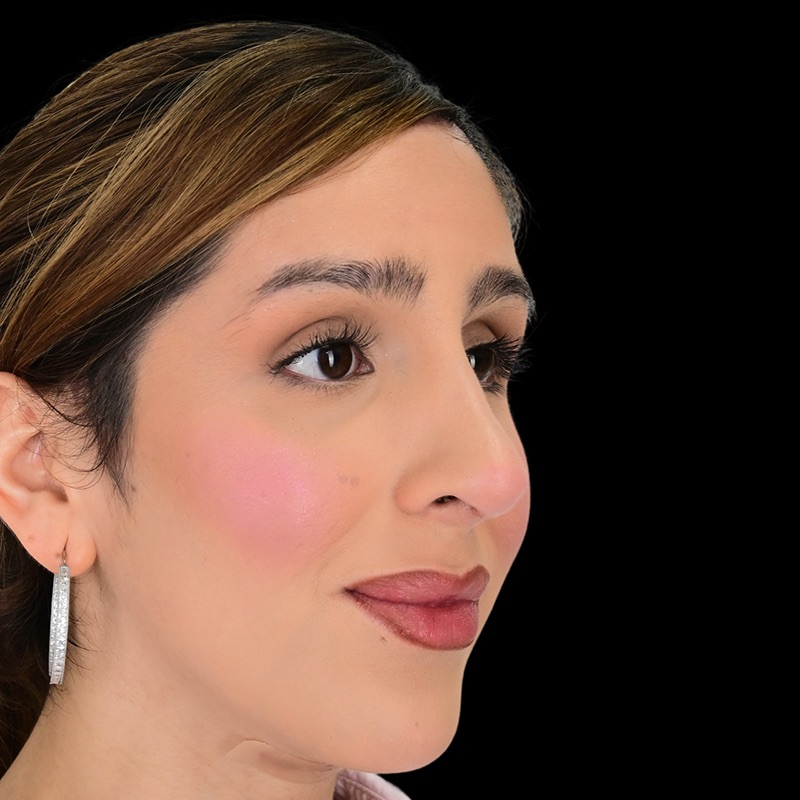 Rhinoplasty Before & After Image