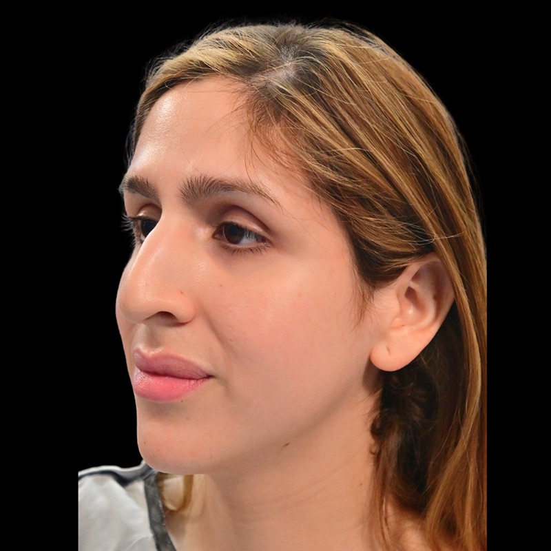 Rhinoplasty Before & After Image