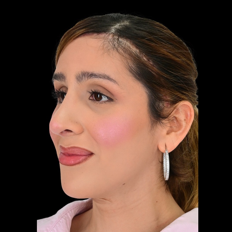 Rhinoplasty Before & After Image