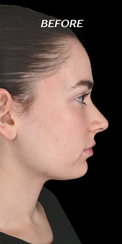 Cheek Fillers Before & After Image