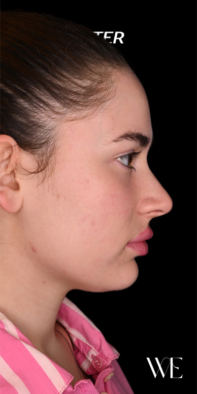 Cheek Fillers Before & After Image