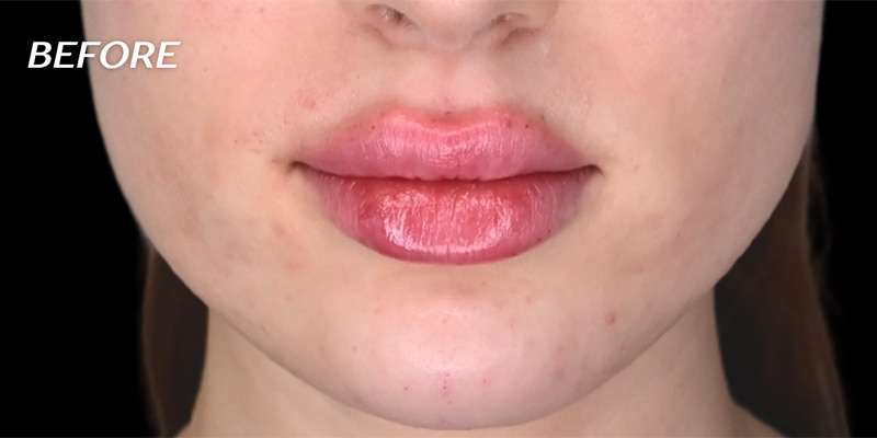 Cheek Fillers Before & After Image