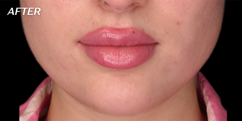 Cheek Fillers Before & After Image