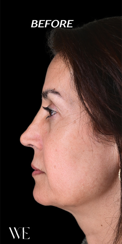 Cheek Fillers Before & After Image