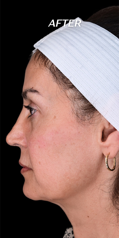 Cheek Fillers Before & After Image