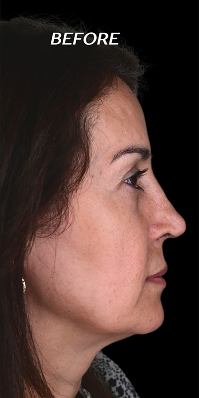 Cheek Fillers Before & After Image