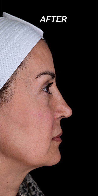 Cheek Fillers Before & After Image