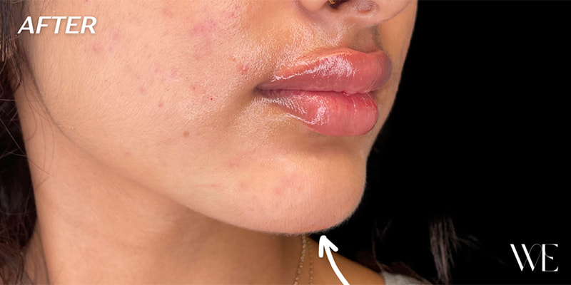 Chin Fillers Before & After Image
