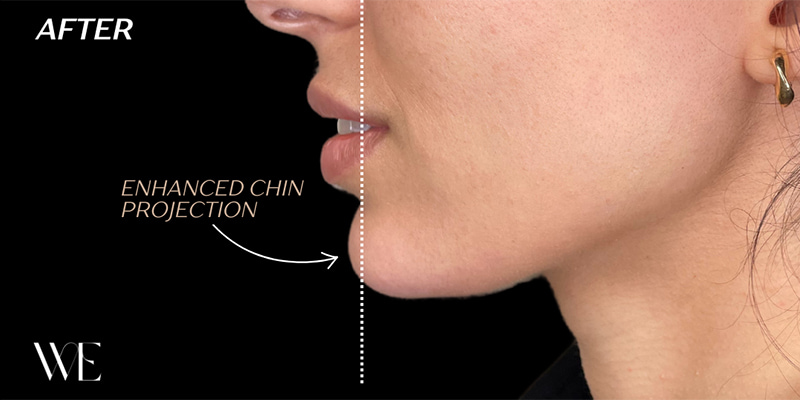 Chin Fillers Before & After Image